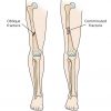 Femur Bone: All you will need to know